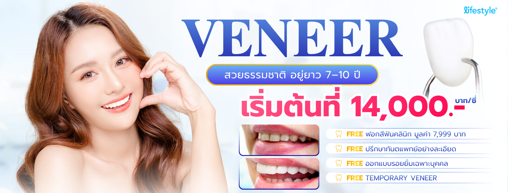 Veneer Promotion 14,000