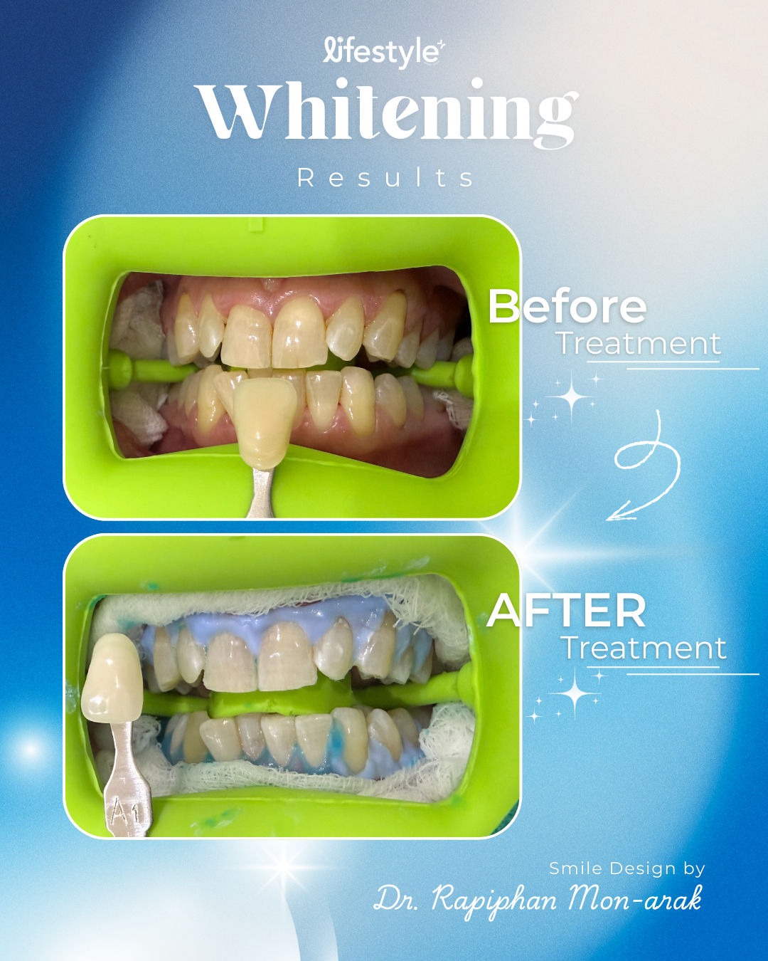 Whitening01
